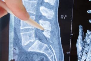 Spinal Surgery Malpractice by Veterans Administration Surgeons Continues